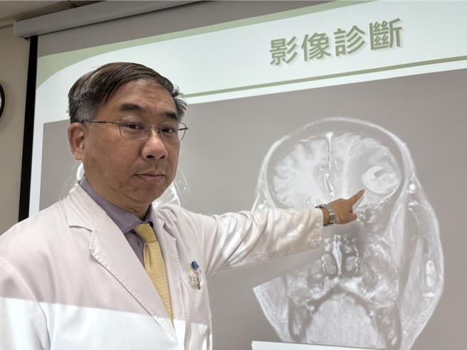 卫福部台中医院神经外科主任陈典廷表示，多形性胶质母细胞瘤症状依照肿瘤压迫位置可能出现头痛、噁心想吐、肢体乏力、个性改变等症状，1名60岁患者因压迫到前额叶情绪区原本能言善道变成沉默哥。（冯惠宜摄）