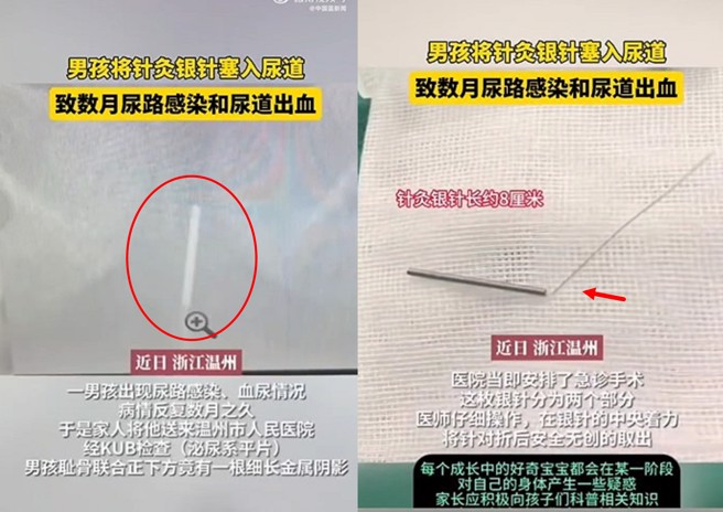 大陸溫州一名男童因為好奇心，竟拿針灸銀針插入尿道。（圖 /翻攝微博）