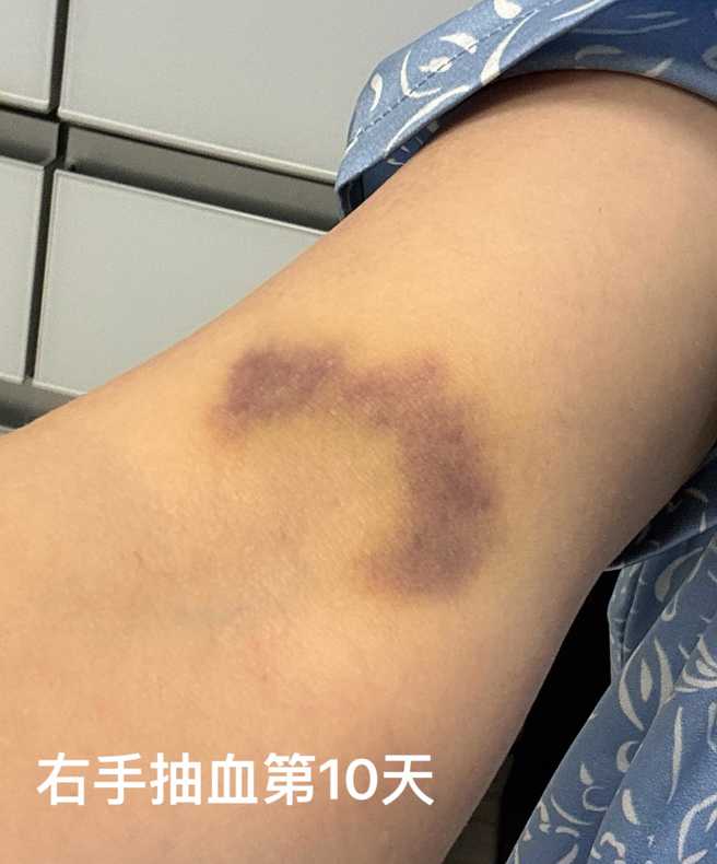 辛晓琪说抽血后十天，手上还是大片瘀青。（图／辛晓琪脸书）