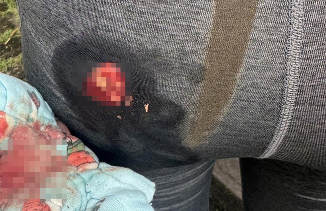 吳小姐遭水牛攻擊，左臀皮開肉綻、鮮血直流。（民眾提供／吳佩蓉宜蘭傳真）