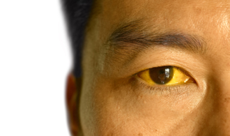 年轻男3餐不正常竟「全身发黄」 送医惊见胆管布满结石