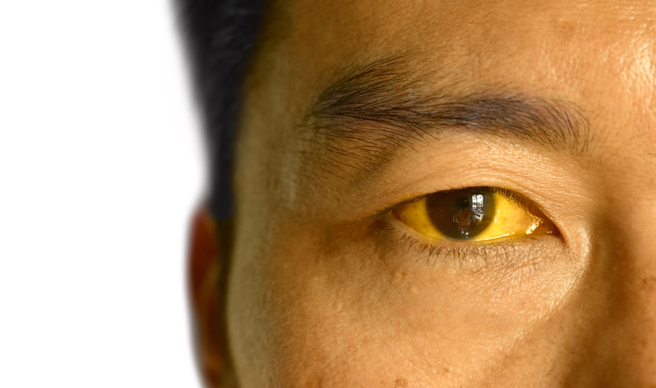 年輕男3餐不正常竟「全身發黃」，送醫驚見膽管布滿結石。（示意圖：shutterstock／達志）