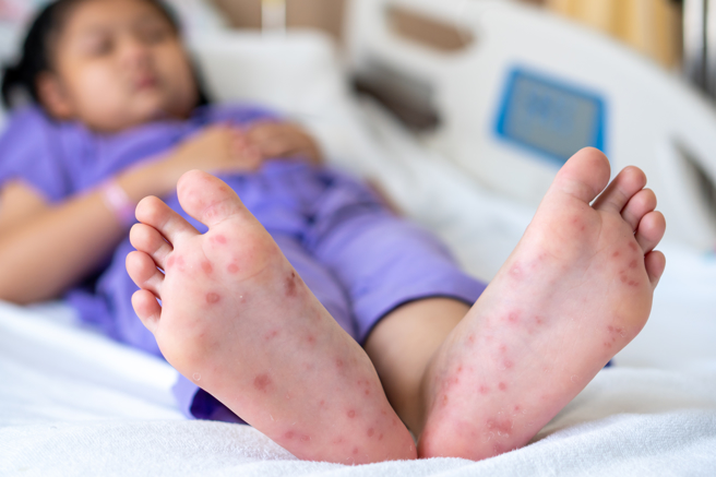 時序入秋，臨床上仍有不少小朋友罹患腸病毒。（示意圖，Shutterstock／達志）