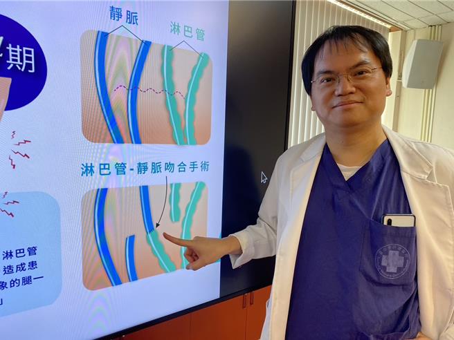 台中荣总淋巴水肿医疗中心主任赖志升说明，透过显微手术将淋巴管和静脉管接合可改善癌后淋巴水肿。（冯惠宜摄）
