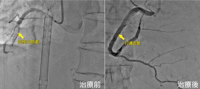 74岁阿嬷因突然呼吸喘急被送医治疗，经心电图和心导管检查发现右冠状动脉被血栓完全阻塞（左），经打通后（右）恢復血流。（澄清医院提供／冯惠宜台中传真）