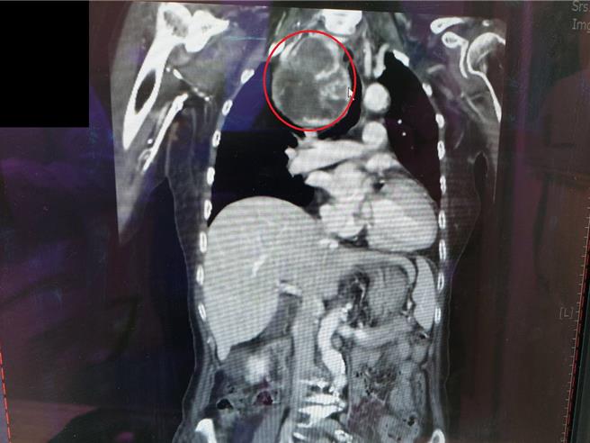 黃奶奶經檢查發現一顆巨大甲狀腺腫瘤，直接壓迫氣管，造成呼吸困難。（大千醫院提供／謝明俊苗栗傳真）