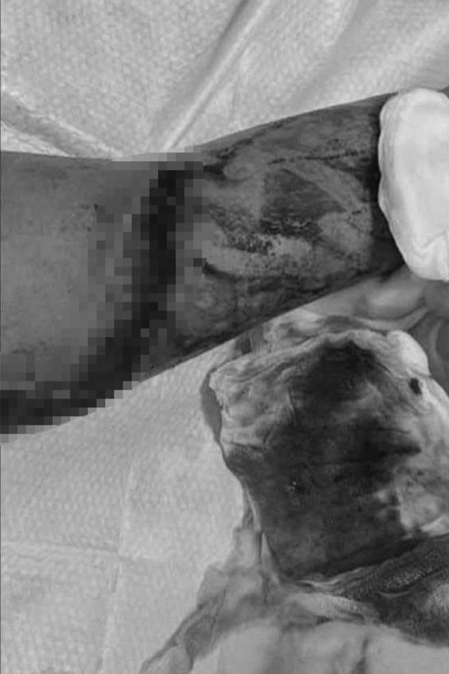 李男以手臂保護頭部，前臂遭刀刃砍傷，血肉模糊。（民眾提供／蕭嘉蕙台東傳真）