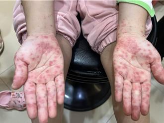 腸病毒肆虐！5歲女童四肢冒水泡 專家曝：恐延燒至跨年