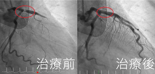患者經過搶救治療後，成功打通血管。（亞大醫院提供／馮惠宜台中傳真）