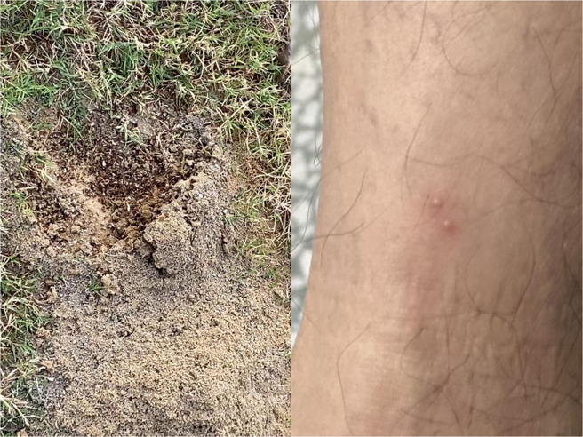 苗栗县头份市永贞国小操场近日遭红火蚁入侵，原本发现8处蚁穴，近期已扩散至12处。左图为红火蚁踪迹；右图为校方巡视校园操场时被红火蚁咬伤。（永贞国小提供／吕丽甄苗栗传真）