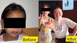 羅慧夫基金會赴菲義診 送4歲顱顏裂女孩最美生日禮物