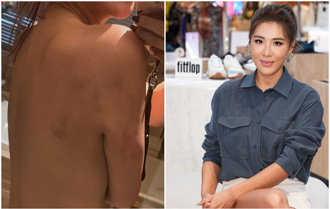 小祯突PO「上半身没穿衣」照 揭20几年旧疾