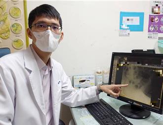 8旬嬤腹脹如球！卵巢癌致腸阻塞 大腸支架救一命