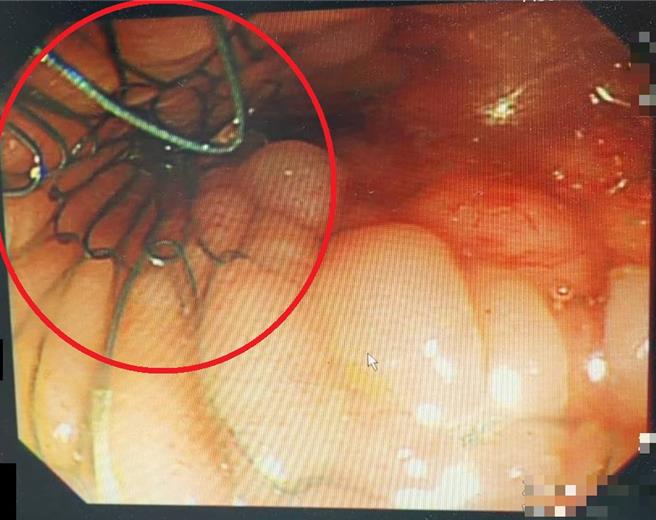 李奶奶使用大肠金属支架(红圈处)后，隔天顺利排气及排便。（大千医院提供／谢明俊苗栗传真）