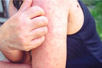 北部新增1本土麻疹！共與102人接觸 感染源仍調查中