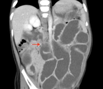 水晶寶寶危機！幼兒誤食險釀腸阻塞 醫提醒勿做1事