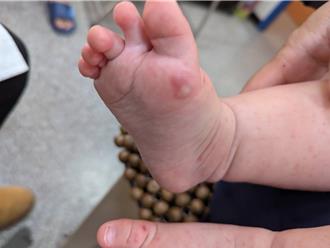 腸病毒狂燒！不只手足口症 國中少男生殖器也遭殃