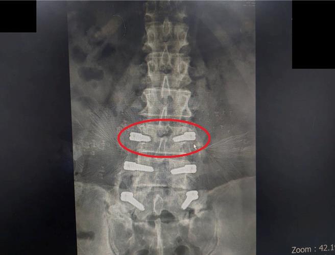 張先生因細菌感染，造成腰椎鋼釘鬆脫（紅圈處）。（大千醫院提供／謝明俊栗傳真）