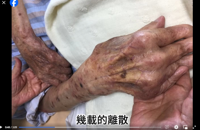 琼瑶晒出平鑫涛在病榻上时，手臂满是淤血和青筋。（图／翻摄自琼瑶脸书）