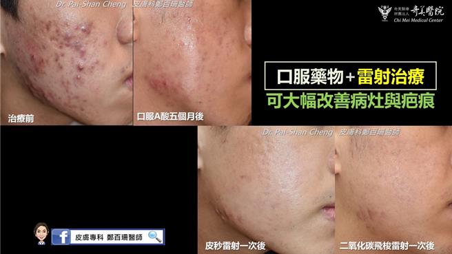奇美醫院醫學美容中心副主任暨皮膚科主治醫師鄭百珊提醒,一旦痘疤形成,要達到完美的治療效果並非一蹴可幾,需要耐心接受連續多次的治療,才能達到最好的治療效果。(奇美醫院提供/曹婷婷台南傳真)