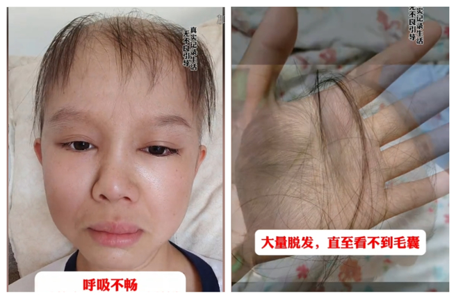 卜娜娜因罹患「鼻窦部腺泡状横纹肌肉瘤」，治疗期间大量掉髮、几乎失明，享年25岁。（图／摄自卜娜娜抖音）