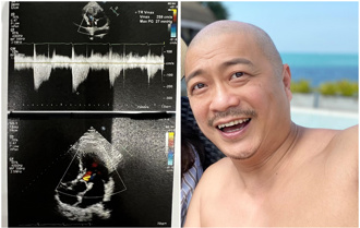 51岁男星「心臟长4.6公分主动脉瘤」：已跟妻交代遗书