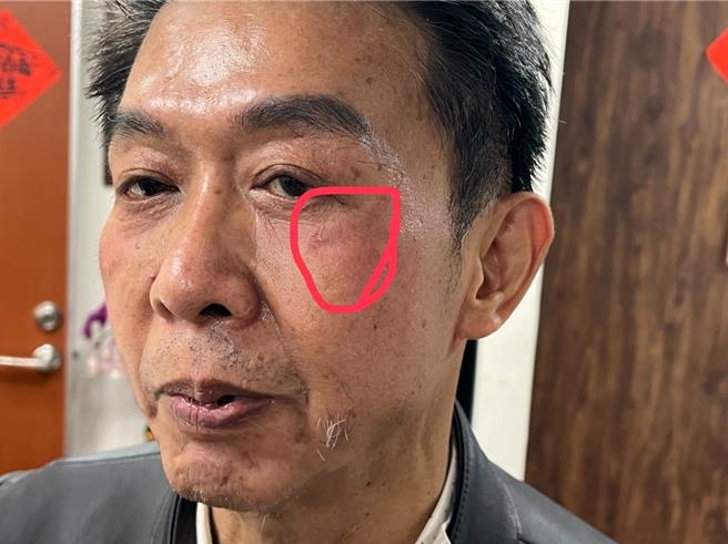 许智杰右下颧骨处挂彩。（许智杰办公室提供／杨亚璇台北传真）