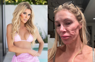 性感女星爆「臉部遭寄生蟲吞噬」砸百萬治療！術前照片太驚恐