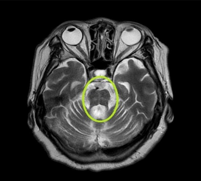 台中71岁黄阿嬷偶有时间感混乱、行走缓慢前兆，家人不以为意，但黄阿嬷近来对外界刺激没有反应甚至晕厥送急诊，才发现脑部核磁共振影像出现「热十字麵包徵候」，罹患罕见「多发性系统萎缩症」。（亚大医院提供／潘虹恩台中传真）