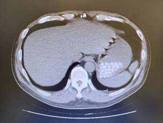 照電腦斷層「胃驚見22顆白點」 急診醫問一句秒笑