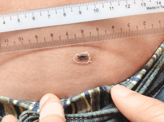 35歲師高燒、肝指數飆 醫在GG旁抓到兇手 致死率60％