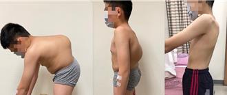 國小男童脊椎側彎超過100度 醫師耗時15小時動1手術助重生