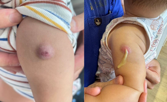 10月男嬰打卡介苗3個月 腫成「流膿小籠包」家長嚇壞