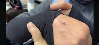 立法院議場陷入混戰  藍委遭咬傷驚喊「是瘋狗嗎？」