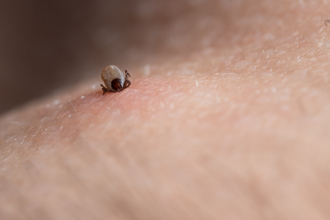 3年来首例「莱姆病」境外移入 法国男返乡遭蜱虫叮咬腿部红疹