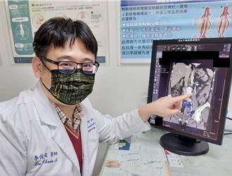 腰酸背痛找不到病因？医揭「骨盆腔郁血」警讯 女性别轻忽