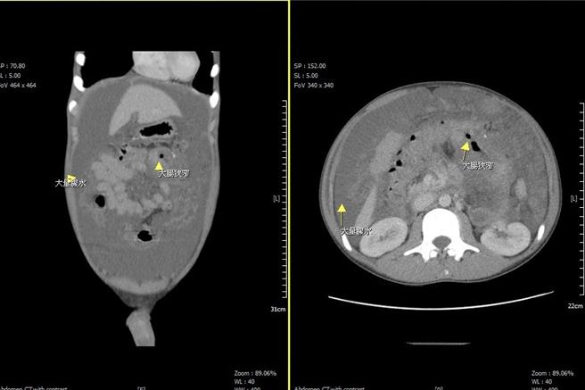 在电脑断层检查下发现大量腹水及大肠狭窄。（大千医院提供／谢明俊苗栗传真）