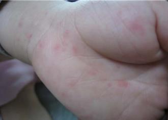 桃园爆首例境外移入麻疹 45岁男染疫 曾出入钱都、大树药局