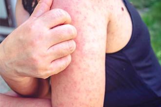 麻疹醫院群聚＋2、柬埔寨移入＋1 相關接觸者超過2000人