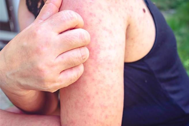 麻疹医院群聚＋2、柬埔寨移入＋1，相关接触者超过2000人。（示意图：shutterstock／达志）