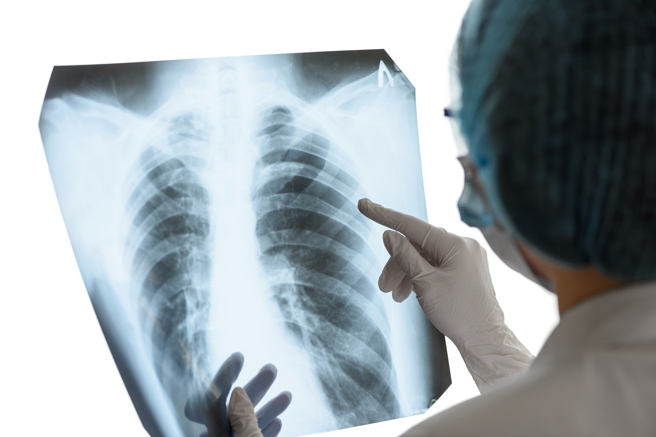 肺部检查若发现有毛玻璃影像，除定期接受追踪外，生活中也要力求远离空污等肺癌危险因子。（示意图，Shutterstock／达志）