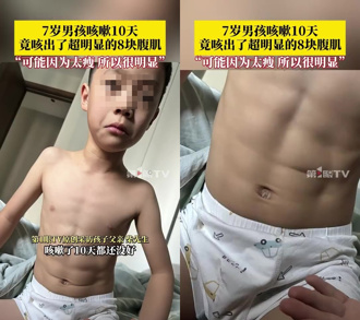 感染流感咳嗽十天 西安7歲男童意外咳出「八塊腹肌」