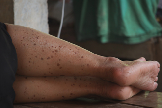 不只水腫！男忽視小腿1徵兆 半年後洗腎了