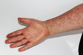 北部男確診麻疹「下台中訪友」曾搭中捷到餐廳吃尾牙