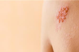皮蛇「长一圈见阎王」？医解析带状疱疹迷思 曝预防之道