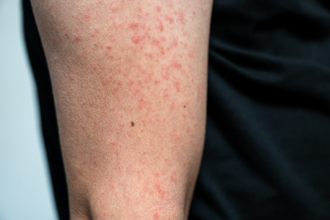 麻疹疫情接觸者破3千人 感染專家建議做1事自保