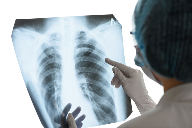 6旬婦跌倒胸痛無法呼吸，肺癌篩檢揪出早期腫瘤。（示意圖，Shutterstock／達志）