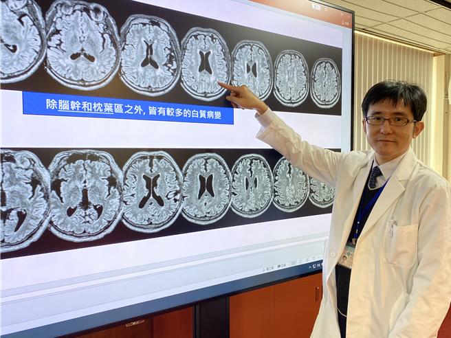 中榮失智症中心主任李威儒指出，透過磁振造影檢查可看到帶因者在未發病前，腦部已有白質病變（手指處）出現。（台中榮總提供／馮惠宜台中傳真）