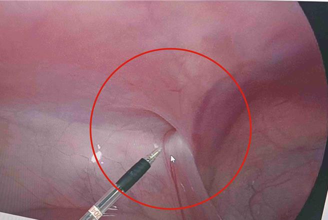 「「疝气」是鼠蹊部有缺损，腹内器官-通常是肠子，会穿过缺损突出于鼠蹊区域，用力、咳嗽或站立时更明显。（彰基医院提供／叶静美彰化传真）