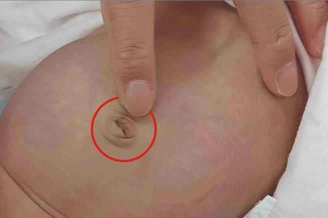 腹腔镜微创单孔疝气修补手术」可同时检查对侧，女婴有「肚脐疝气」，刚好利用此孔洞进入腹腔修补。（彰基医院提供／叶静美彰化传真）
